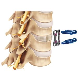 Cervical Plate and Screws Manufacturer